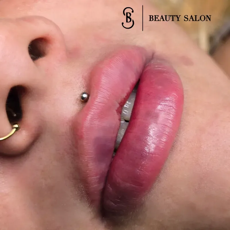 Aumento de Labios con Ácido hialurónico 150USD