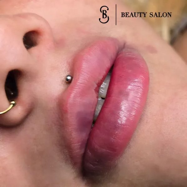 Aumento de Labios con Ácido hialurónico 150USD