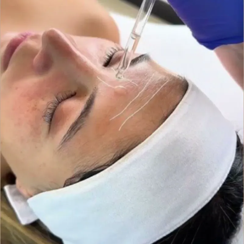 Hilos reabsorbibles de colágeno