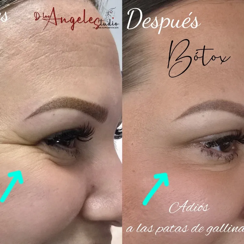 Botox en Tercio Superior del Rostro.