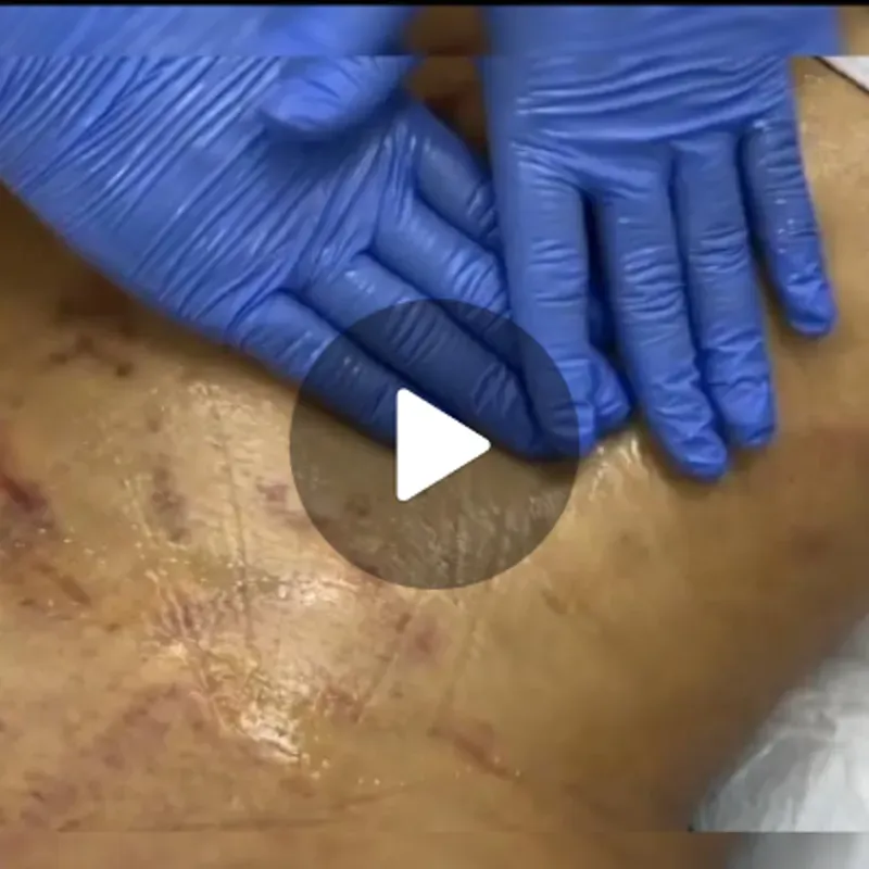 Masaje post quirúrgico (5 primeras sesiones)