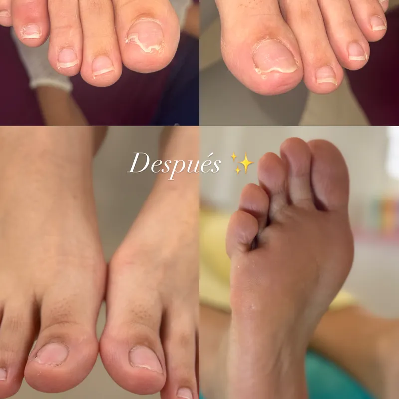 Tratamiento contra micosis (Hongos)