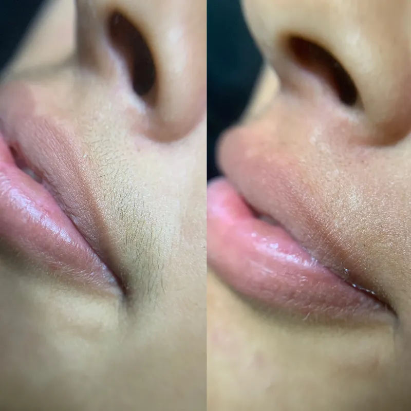 Depilación de Bozo y Mentón