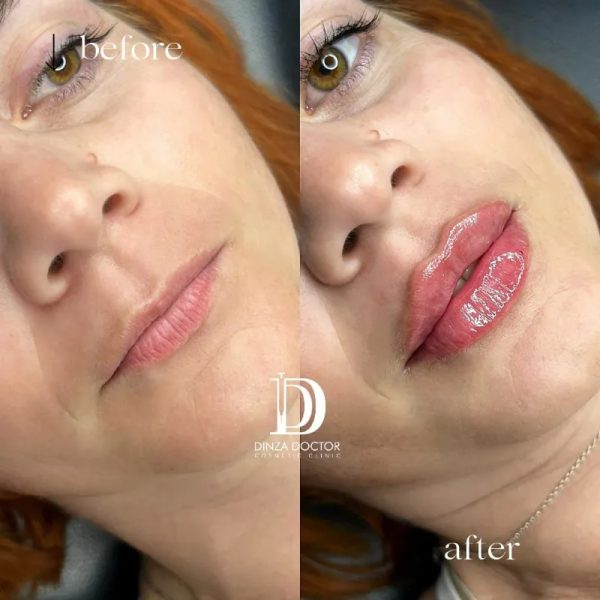 Aumento de Labios 