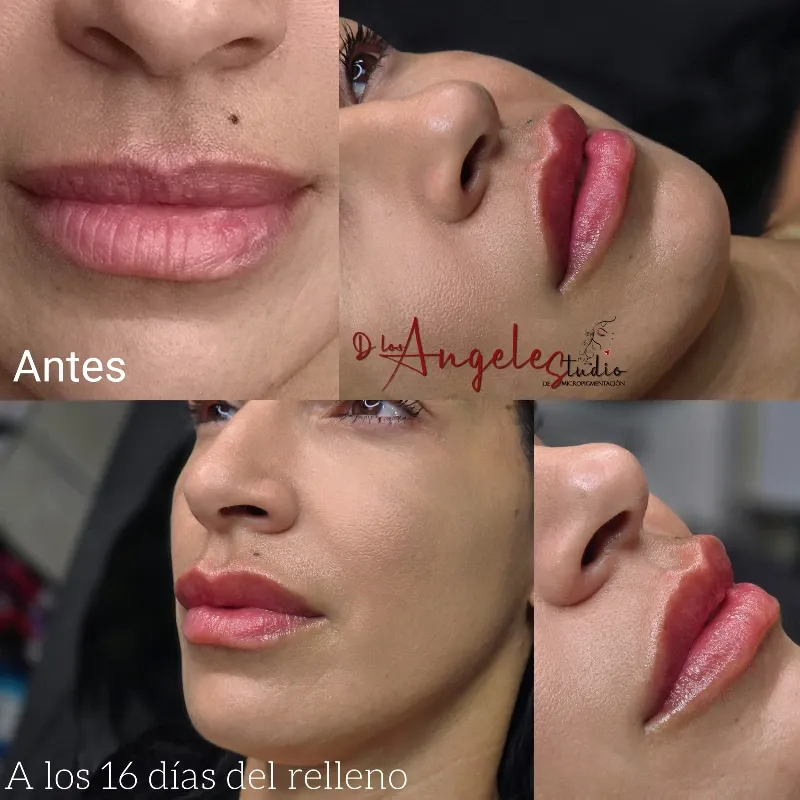 Relleno de Labios con Ácido Hialuronico/ 1mL.