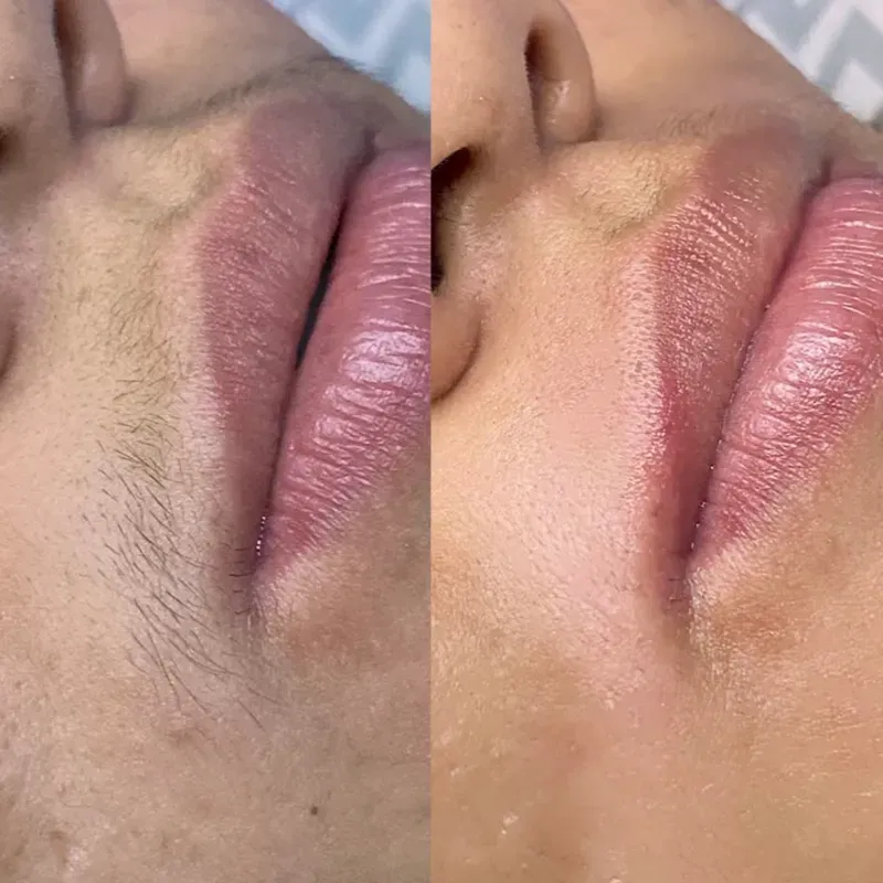 Depilación de bigote y bozo