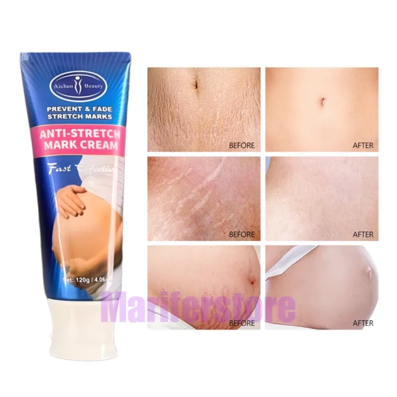 Aichun Beauty – Crema antiestrías preventivo y correctivo