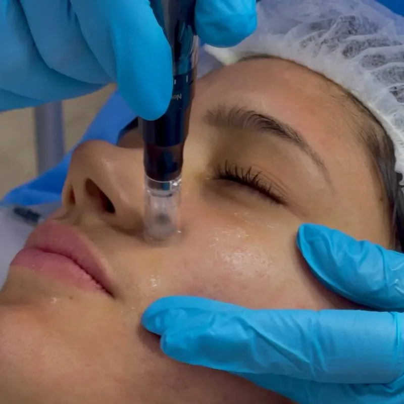 Micropunción Estándar