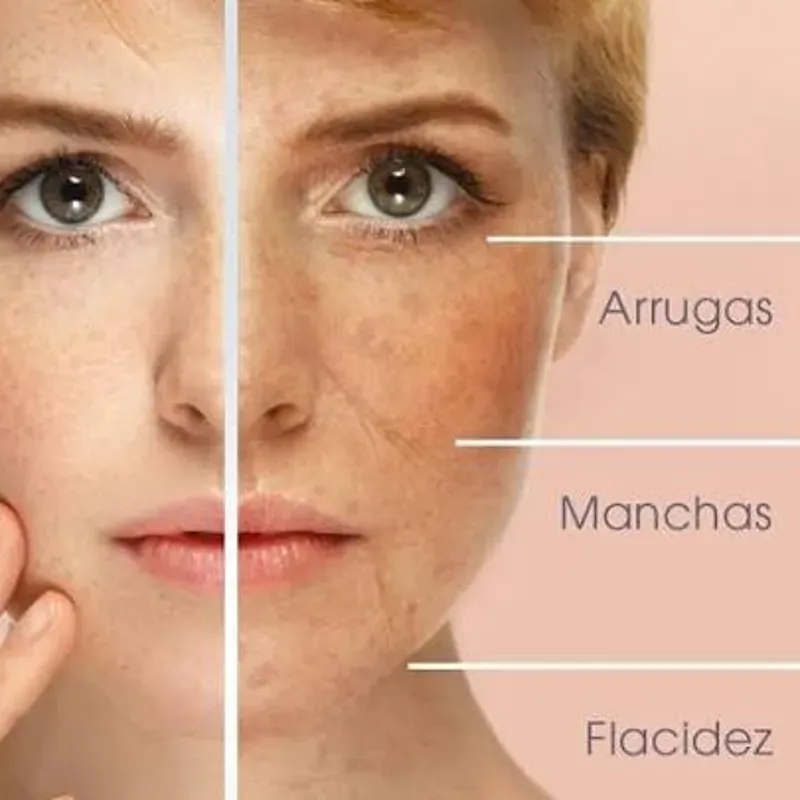 TRATAMIENTO DE ARRUGAS Y LÍNEAS DE EXPRESIÓN EN ROSTRO COMPLETO