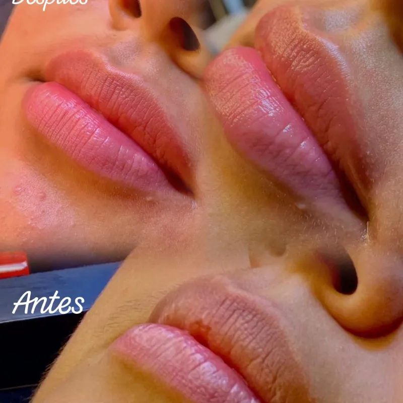Tratamiento BBlips