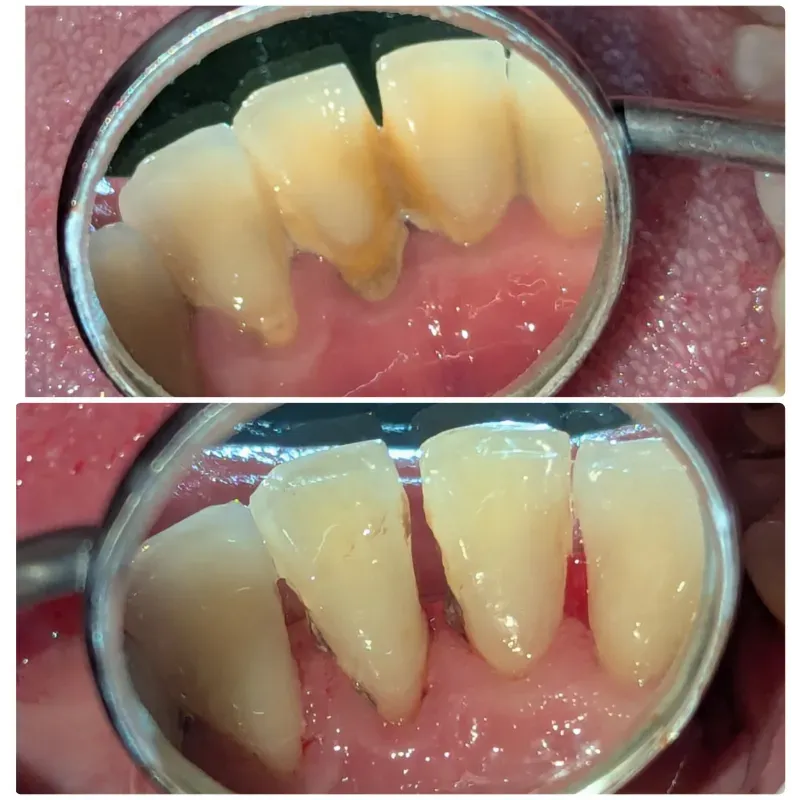 Tartrectomia (Limpieza)