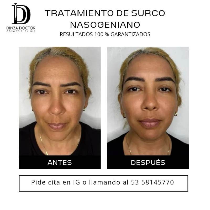 Relleno de surcos nasogenianos ✨