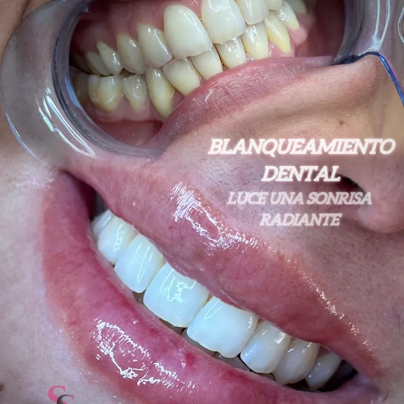 Blanqueamiento Dental