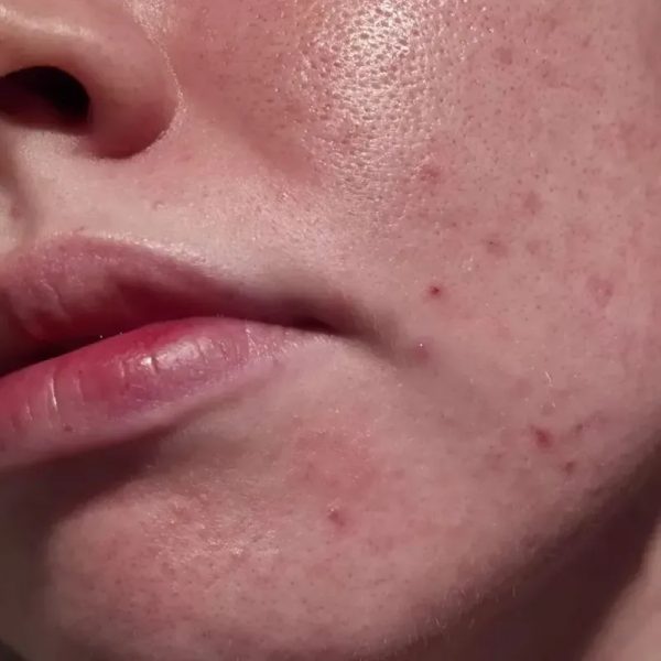 Cutis seborreico