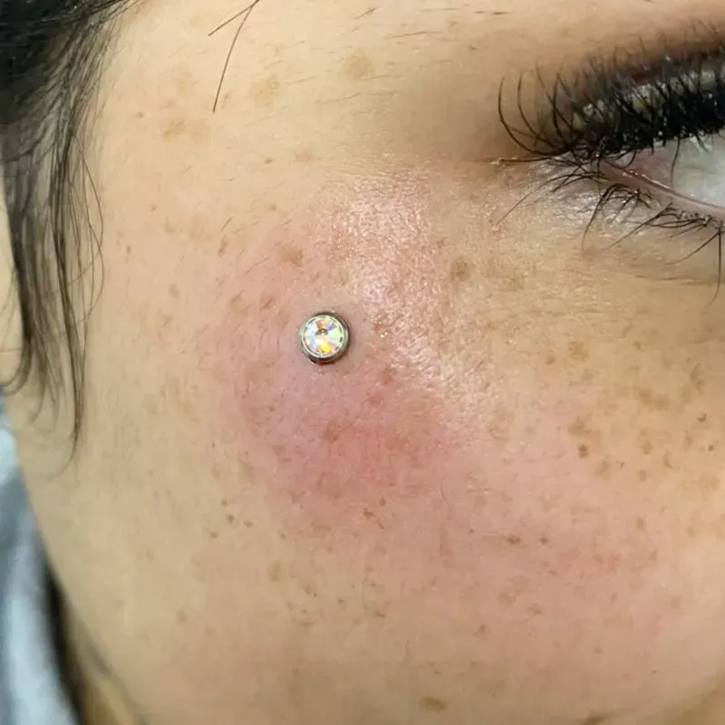 Microdermal (unidad)
