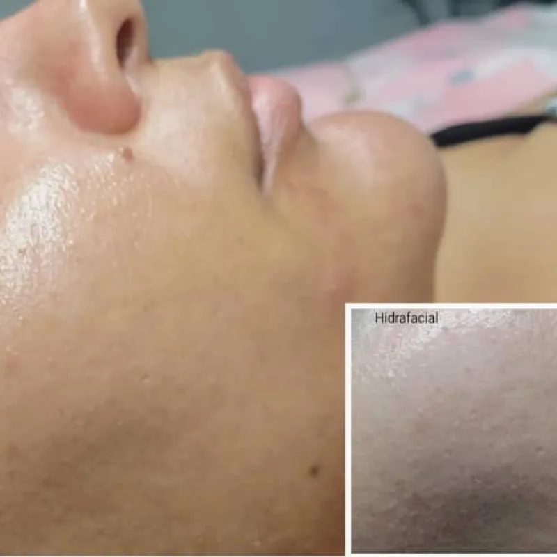 Hidrafacial