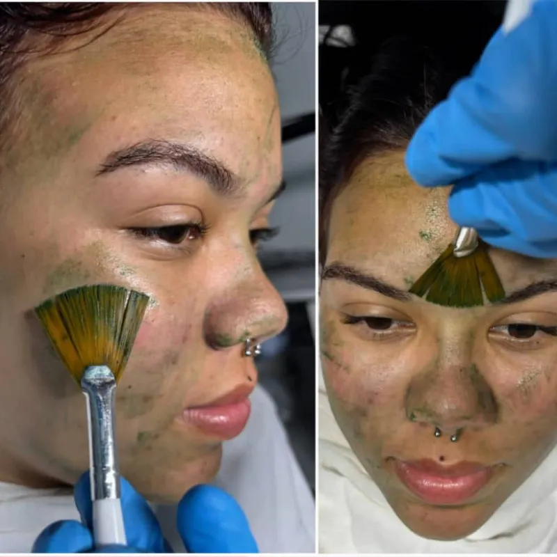 Biomicroneedling facial