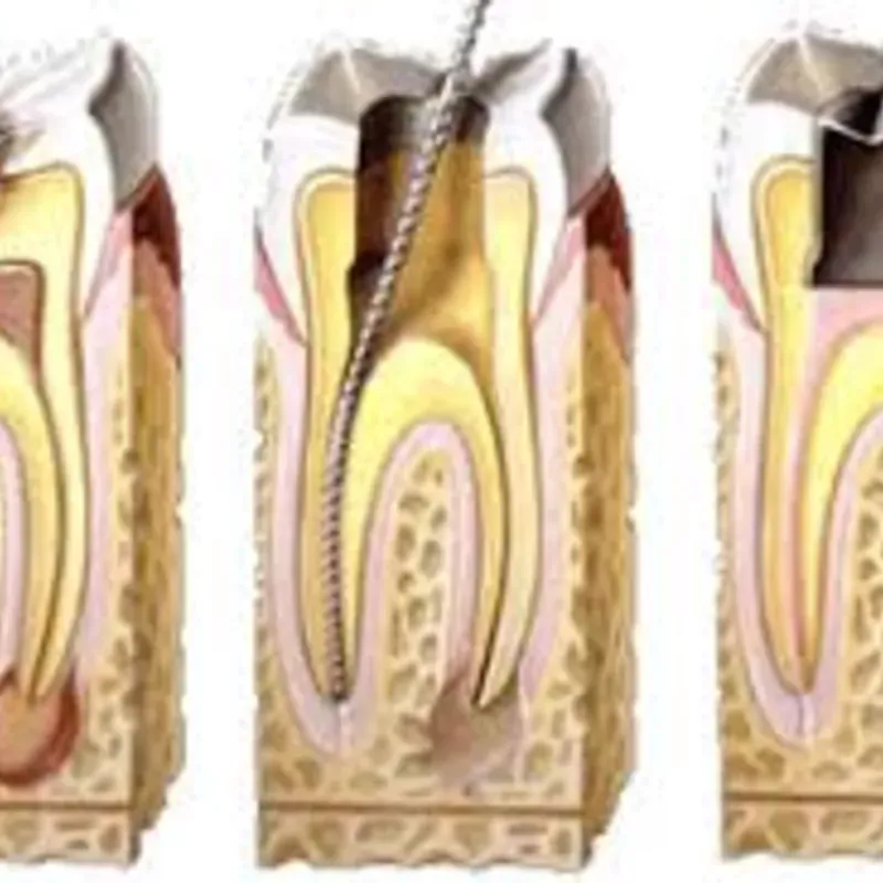 Tratamiento de Conducto (TPR)