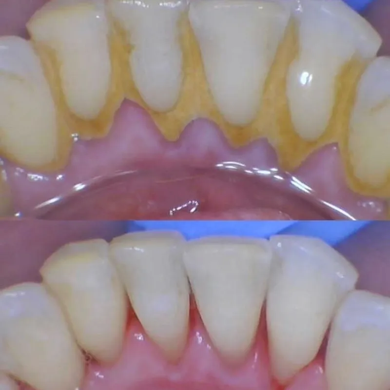 Limpieza Bucodental Profunda
