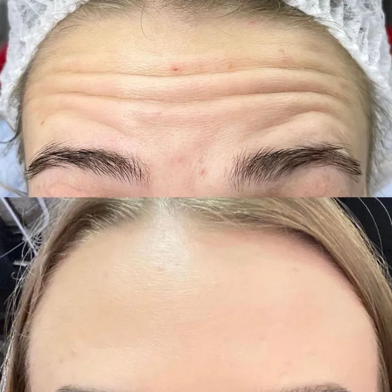 Toxina Botulinica (Botox)