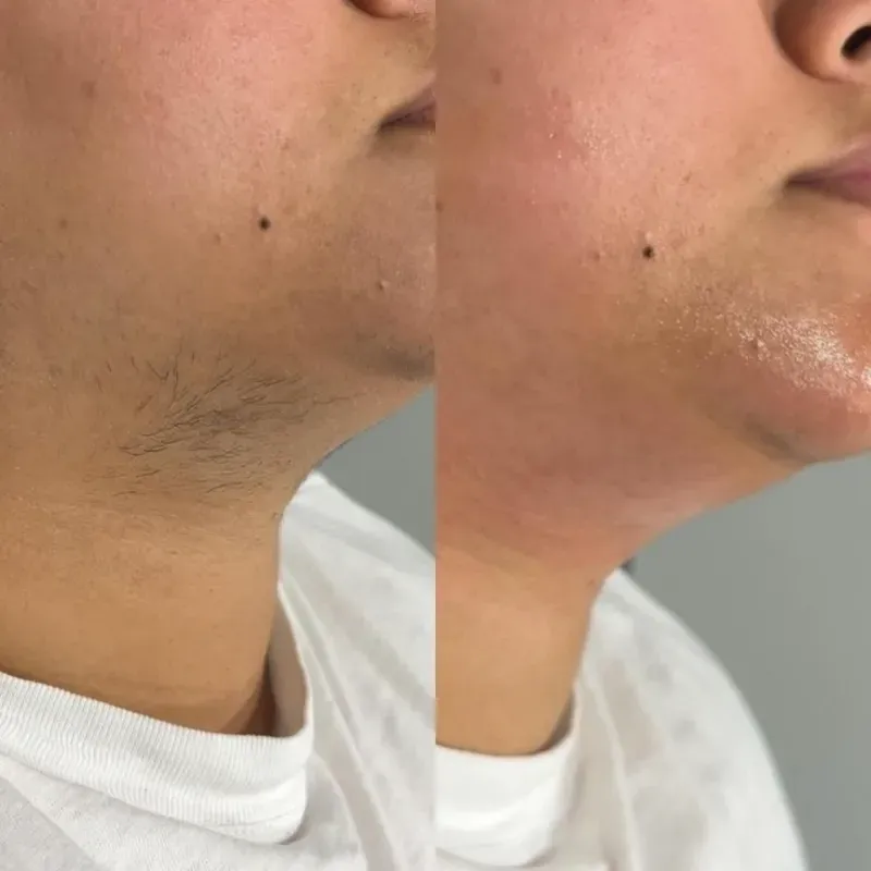 Depilación de barbilla