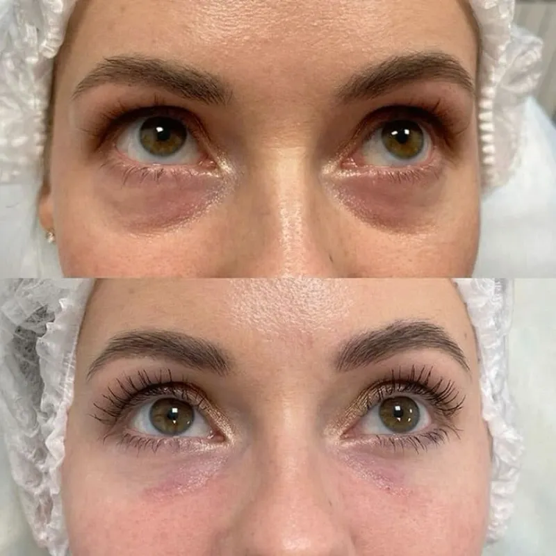 Relleno de Ojeras.