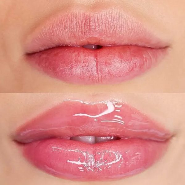 Hydralips