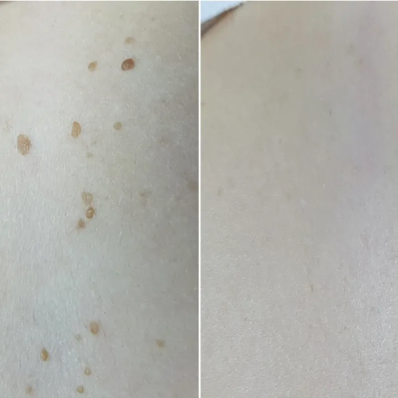 Eliminación de queratosis