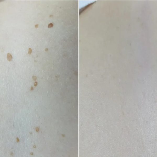 Eliminación de queratosis