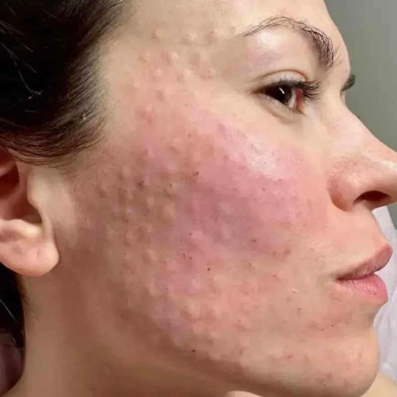 ADN de salmón PDNR.Tecnología de regeneración celular