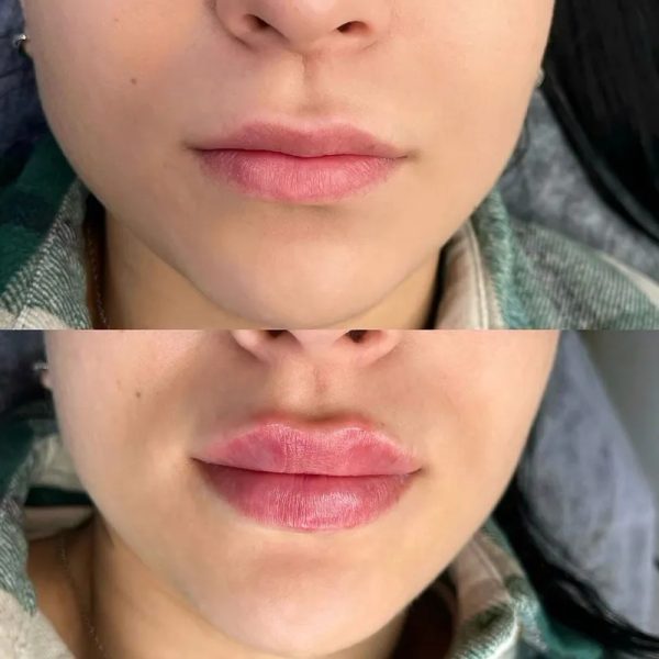 Labios. Rellenos con Ácido Hialurónico