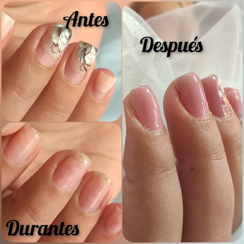 Retiro de uñas