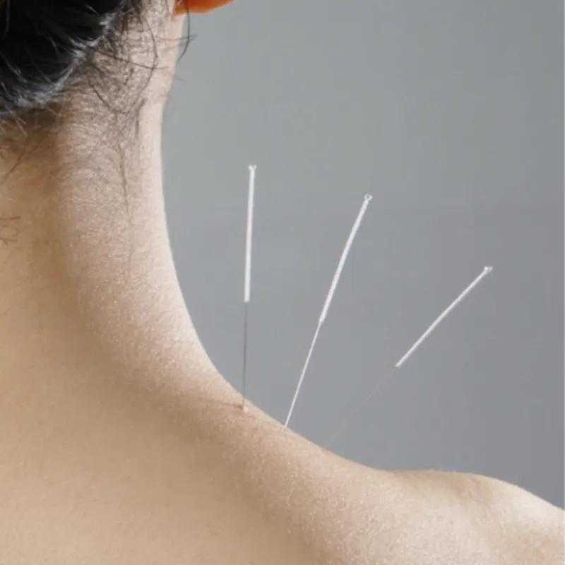 Acupuntura
