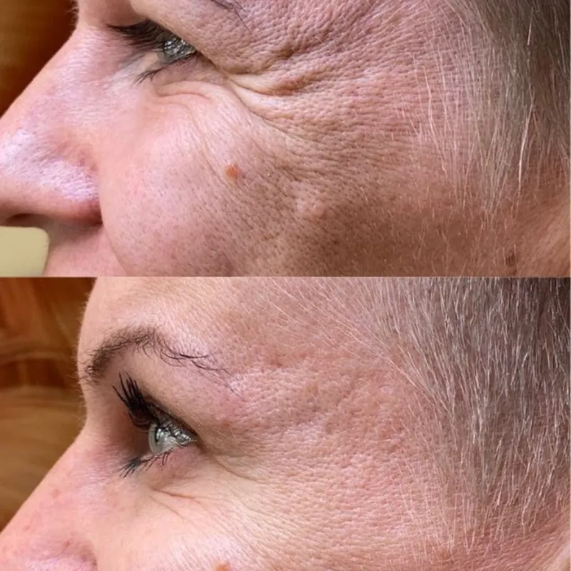 Botox en patas de gallo