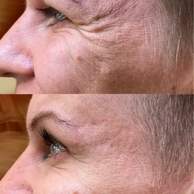 Botox en patas de gallo