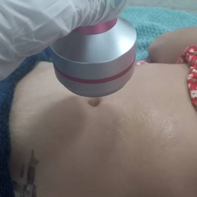 Cavitación (Grasa Localizada en Abdomen)