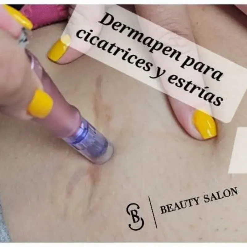 Dermapen para estrías