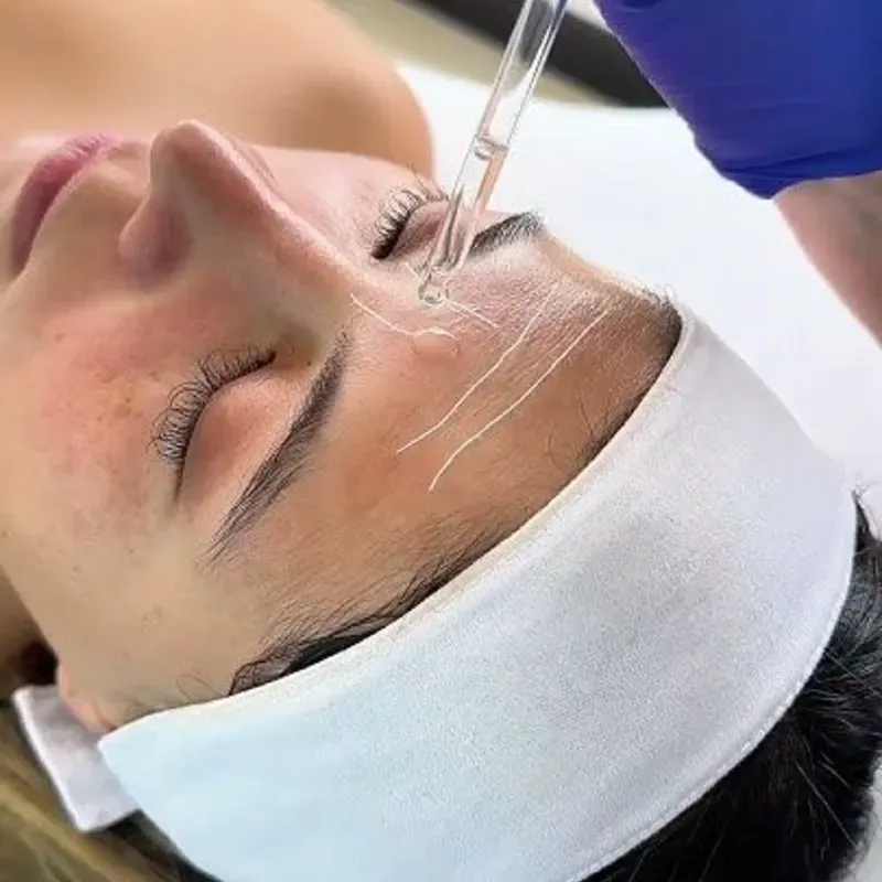 Tratamiento con hilos de colageno
