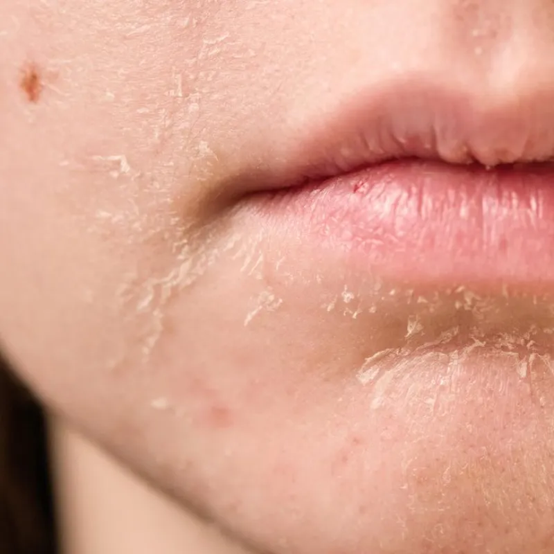 Tratamiento nutritivo e hidratante