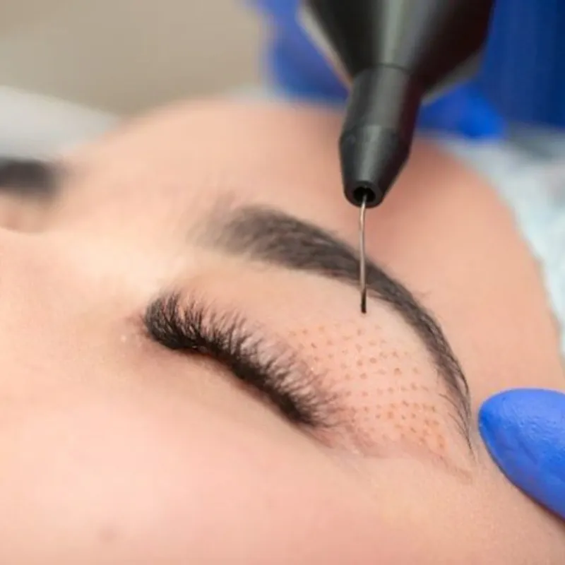 Fibroblast Plasma Pen