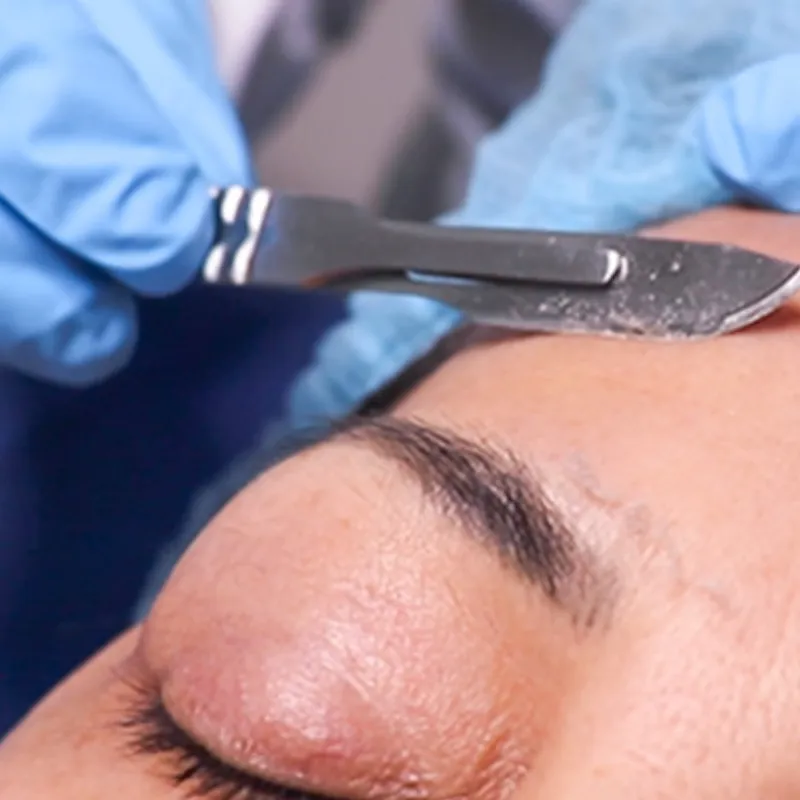 Dermaplaning