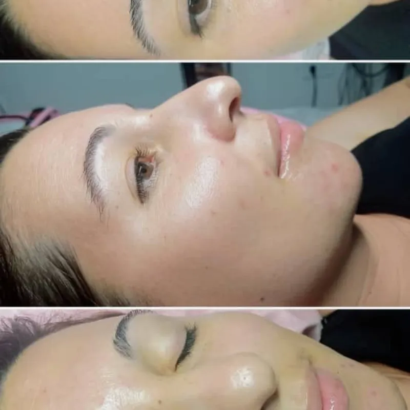 Biomicroneedling Facial