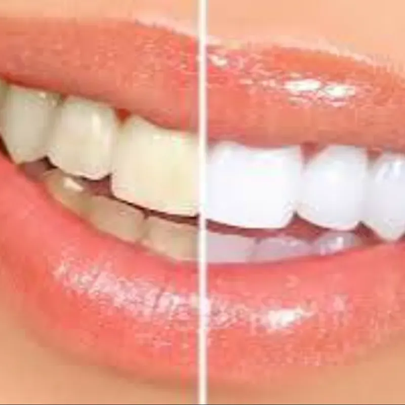 Blanquemiento Dental