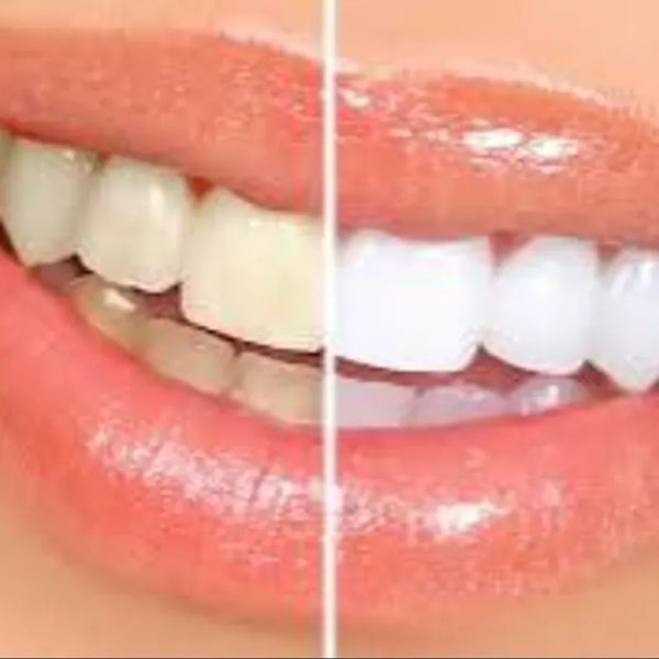 Blanquemiento Dental