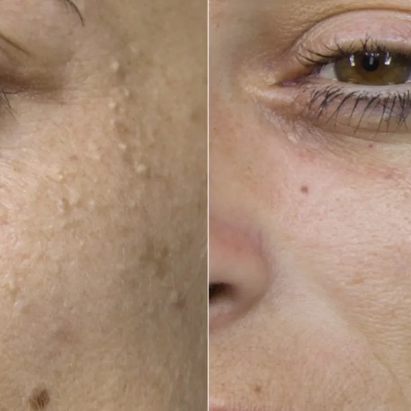 Eliminación de milias