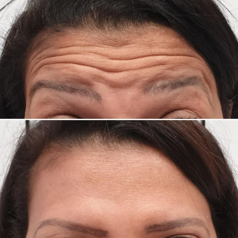 Botox en frente (toxina botulínica)