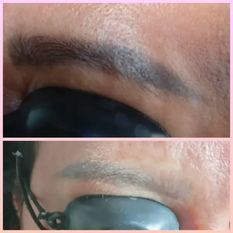 Remoción de pigmento.