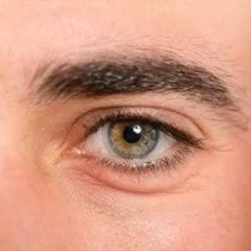 ELIMINACIÓN DE BOLSAS Y OJERAS EN PÁRPADOS INFERIORES