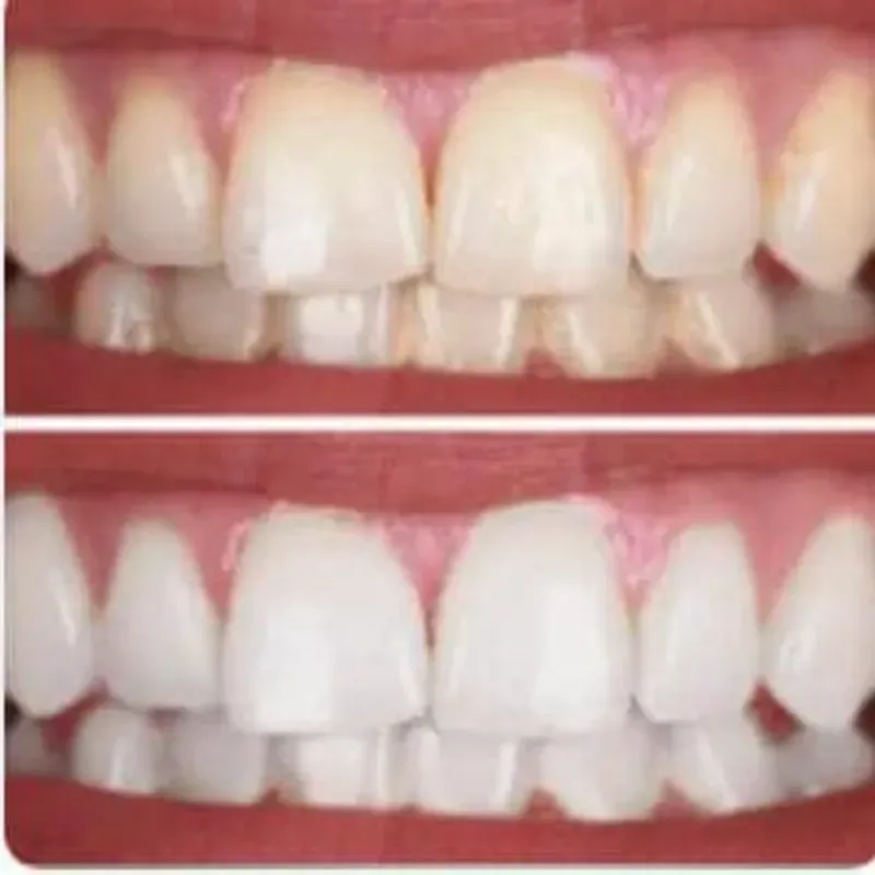 Blanqueamiento bucal