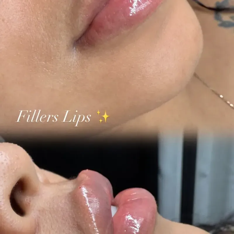 Aumento y perfilado de labios con ácido hialurónico